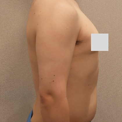 실라인 FLEX 주사 시술 후 술배가 제거된 옆구리, 팔 옆모습 사진