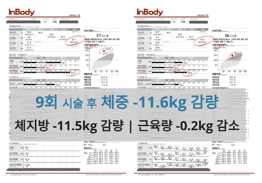 인바디 검사지: 9회 시술 후 체중 -11.6kg, 체지방 -11.5kg 감량 결과